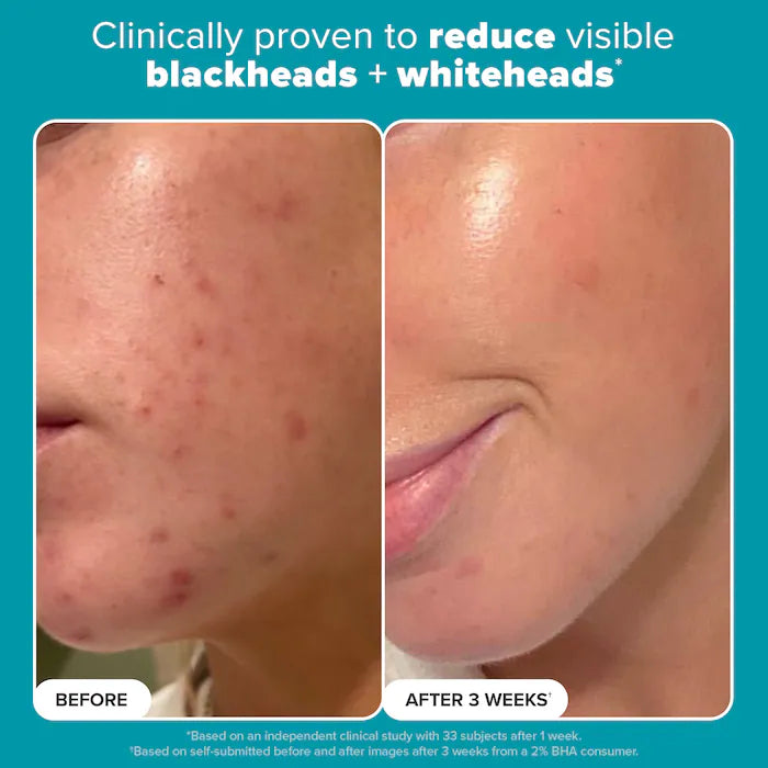 Paula's Choice Skin Perfecting 2% BHA Exfoliating Toner for Clear Skin